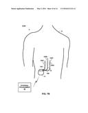 PAIRED STIMULATION PULSES BASED ON SENSED COMPOUND ACTION POTENTIAL diagram and image