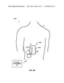 PAIRED STIMULATION PULSES BASED ON SENSED COMPOUND ACTION POTENTIAL diagram and image