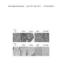 Galectin-3 Inhibitor (Gal-3M) is Associated with Additive Anti-Myeloma and     Anti-Solid Tumor Effects, Decreased Osteoclastogenesis and Organ     Protection when Used in Combination with Proteasome Inhibitors diagram and image