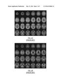 AMYLOID PET BRAIN SCAN QUANTIFICATION BASED ON CORTICAL PROFILES diagram and image