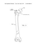 METHOD AND APPARATUS FOR ATTACHING TISSUE TO BONE, INCLUDING THE PROVISION     AND USE OF A NOVEL KNOTLESS SUTURE ANCHOR SYSTEM, INCLUDING A NOVEL     LOCKING ELEMENT diagram and image