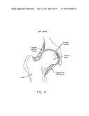 METHOD AND APPARATUS FOR ATTACHING TISSUE TO BONE, INCLUDING THE PROVISION     AND USE OF A NOVEL KNOTLESS SUTURE ANCHOR SYSTEM, INCLUDING A NOVEL     LOCKING ELEMENT diagram and image