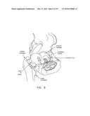 METHOD AND APPARATUS FOR ATTACHING TISSUE TO BONE, INCLUDING THE PROVISION     AND USE OF A NOVEL KNOTLESS SUTURE ANCHOR SYSTEM, INCLUDING A NOVEL     LOCKING ELEMENT diagram and image