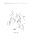 METHOD AND APPARATUS FOR ATTACHING TISSUE TO BONE, INCLUDING THE PROVISION     AND USE OF A NOVEL KNOTLESS SUTURE ANCHOR SYSTEM, INCLUDING A NOVEL     LOCKING ELEMENT diagram and image