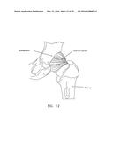 METHOD AND APPARATUS FOR ATTACHING TISSUE TO BONE, INCLUDING THE PROVISION     AND USE OF A NOVEL KNOTLESS SUTURE ANCHOR SYSTEM, INCLUDING A NOVEL     LOCKING ELEMENT diagram and image