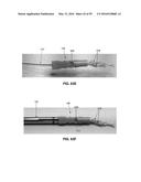 METHOD AND APPARATUS FOR ATTACHING TISSUE TO BONE, INCLUDING THE PROVISION     AND USE OF A NOVEL KNOTLESS SUTURE ANCHOR SYSTEM, INCLUDING A NOVEL     LOCKING ELEMENT diagram and image