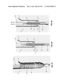 METHOD AND APPARATUS FOR ATTACHING TISSUE TO BONE, INCLUDING THE PROVISION     AND USE OF A NOVEL KNOTLESS SUTURE ANCHOR SYSTEM, INCLUDING A NOVEL     LOCKING ELEMENT diagram and image