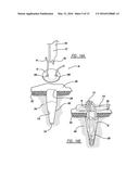 FLEXIBLE PLANAR MEMBER FOR TISSUE FIXATION diagram and image