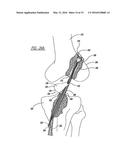 FLEXIBLE PLANAR MEMBER FOR TISSUE FIXATION diagram and image