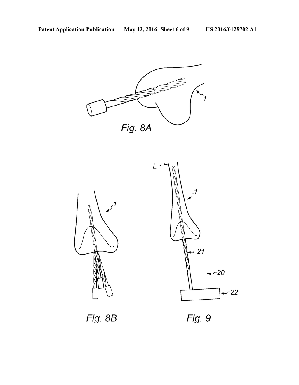 DISTAL FEMORAL JIG ASSEMBLY - diagram, schematic, and image 07