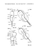 TISSUE DISPLACEMENT TOOLS AND METHODS diagram and image