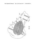 TISSUE DISPLACEMENT TOOLS AND METHODS diagram and image