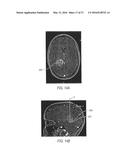 SURGICAL ACCESS SYSTEM WITH NAVIGATION ELEMENT AND METHOD OF USING SAME diagram and image