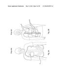 SUBCUTANEOUS IMPLANTABLE DEVICE FOR GRADUALLY ALIGNING A SPINE AND     SUBCUTANEOUS IMPLANTABLE DEVICE FOR GRADUALLY LENGTHENING A BONE diagram and image