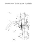 SUBCUTANEOUS IMPLANTABLE DEVICE FOR GRADUALLY ALIGNING A SPINE AND     SUBCUTANEOUS IMPLANTABLE DEVICE FOR GRADUALLY LENGTHENING A BONE diagram and image