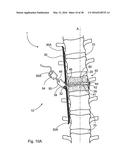 SUBCUTANEOUS IMPLANTABLE DEVICE FOR GRADUALLY ALIGNING A SPINE AND     SUBCUTANEOUS IMPLANTABLE DEVICE FOR GRADUALLY LENGTHENING A BONE diagram and image