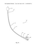 SUBCUTANEOUS IMPLANTABLE DEVICE FOR GRADUALLY ALIGNING A SPINE AND     SUBCUTANEOUS IMPLANTABLE DEVICE FOR GRADUALLY LENGTHENING A BONE diagram and image