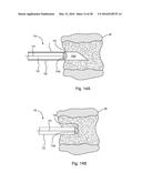 SUBCUTANEOUS IMPLANTABLE DEVICE FOR GRADUALLY ALIGNING A SPINE AND     SUBCUTANEOUS IMPLANTABLE DEVICE FOR GRADUALLY LENGTHENING A BONE diagram and image