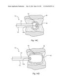 SUBCUTANEOUS IMPLANTABLE DEVICE FOR GRADUALLY ALIGNING A SPINE AND     SUBCUTANEOUS IMPLANTABLE DEVICE FOR GRADUALLY LENGTHENING A BONE diagram and image