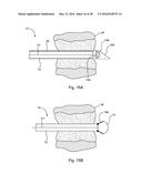 SUBCUTANEOUS IMPLANTABLE DEVICE FOR GRADUALLY ALIGNING A SPINE AND     SUBCUTANEOUS IMPLANTABLE DEVICE FOR GRADUALLY LENGTHENING A BONE diagram and image