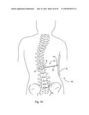 SUBCUTANEOUS IMPLANTABLE DEVICE FOR GRADUALLY ALIGNING A SPINE AND     SUBCUTANEOUS IMPLANTABLE DEVICE FOR GRADUALLY LENGTHENING A BONE diagram and image