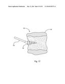 SUBCUTANEOUS IMPLANTABLE DEVICE FOR GRADUALLY ALIGNING A SPINE AND     SUBCUTANEOUS IMPLANTABLE DEVICE FOR GRADUALLY LENGTHENING A BONE diagram and image