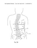 SUBCUTANEOUS IMPLANTABLE DEVICE FOR GRADUALLY ALIGNING A SPINE AND     SUBCUTANEOUS IMPLANTABLE DEVICE FOR GRADUALLY LENGTHENING A BONE diagram and image