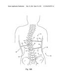 SUBCUTANEOUS IMPLANTABLE DEVICE FOR GRADUALLY ALIGNING A SPINE AND     SUBCUTANEOUS IMPLANTABLE DEVICE FOR GRADUALLY LENGTHENING A BONE diagram and image