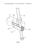 SUBCUTANEOUS IMPLANTABLE DEVICE FOR GRADUALLY ALIGNING A SPINE AND     SUBCUTANEOUS IMPLANTABLE DEVICE FOR GRADUALLY LENGTHENING A BONE diagram and image