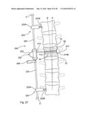 SUBCUTANEOUS IMPLANTABLE DEVICE FOR GRADUALLY ALIGNING A SPINE AND     SUBCUTANEOUS IMPLANTABLE DEVICE FOR GRADUALLY LENGTHENING A BONE diagram and image