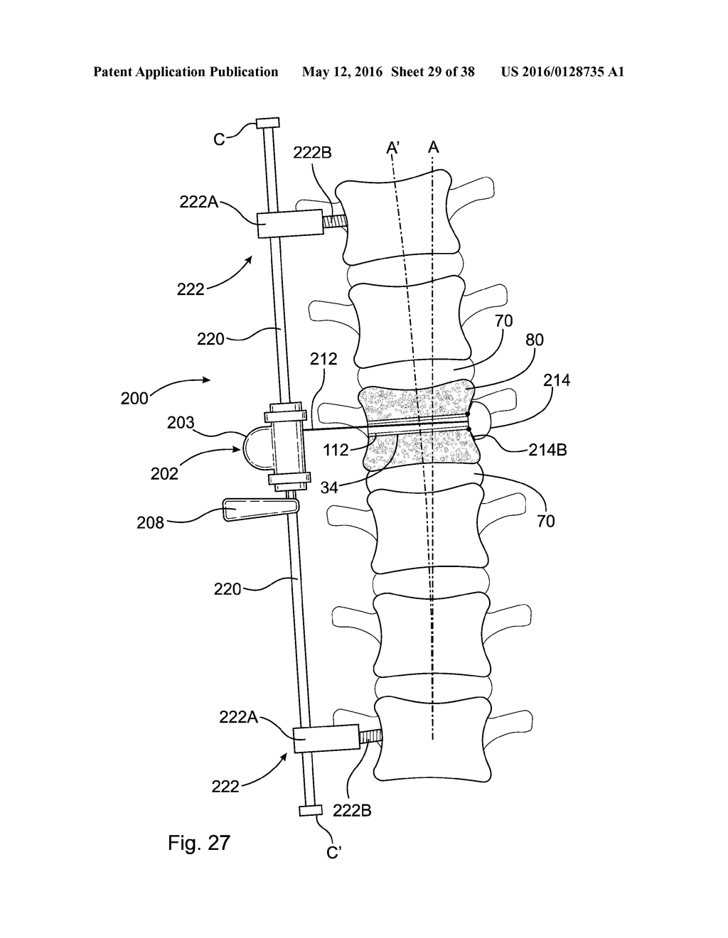 SUBCUTANEOUS IMPLANTABLE DEVICE FOR GRADUALLY ALIGNING A SPINE AND     SUBCUTANEOUS IMPLANTABLE DEVICE FOR GRADUALLY LENGTHENING A BONE - diagram, schematic, and image 30