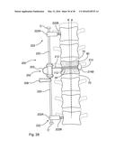 SUBCUTANEOUS IMPLANTABLE DEVICE FOR GRADUALLY ALIGNING A SPINE AND     SUBCUTANEOUS IMPLANTABLE DEVICE FOR GRADUALLY LENGTHENING A BONE diagram and image