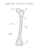 SUBCUTANEOUS IMPLANTABLE DEVICE FOR GRADUALLY ALIGNING A SPINE AND     SUBCUTANEOUS IMPLANTABLE DEVICE FOR GRADUALLY LENGTHENING A BONE diagram and image