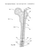 SUBCUTANEOUS IMPLANTABLE DEVICE FOR GRADUALLY ALIGNING A SPINE AND     SUBCUTANEOUS IMPLANTABLE DEVICE FOR GRADUALLY LENGTHENING A BONE diagram and image