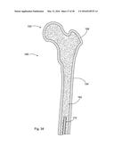 SUBCUTANEOUS IMPLANTABLE DEVICE FOR GRADUALLY ALIGNING A SPINE AND     SUBCUTANEOUS IMPLANTABLE DEVICE FOR GRADUALLY LENGTHENING A BONE diagram and image