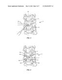 SURGICAL IMPLANT SYSTEM AND METHOD diagram and image