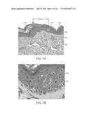 Controlled Photomechanical and Photothermal Treatment of Mucosal Tissue diagram and image