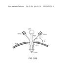 CURVED CANNULA SURGICAL SYSTEM diagram and image