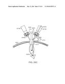 CURVED CANNULA SURGICAL SYSTEM diagram and image