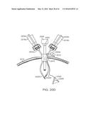 CURVED CANNULA SURGICAL SYSTEM diagram and image