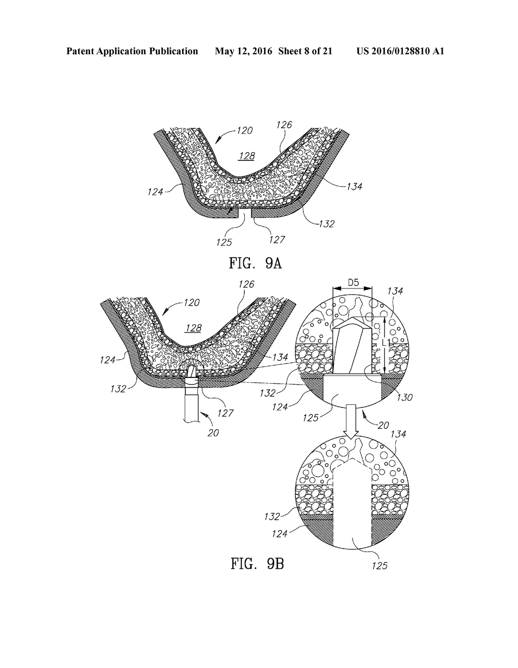 GUIDED SINUS LIFT - diagram, schematic, and image 09