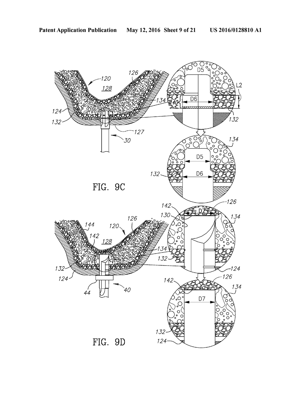 GUIDED SINUS LIFT - diagram, schematic, and image 10