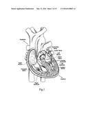 METHODS OF IMPLANTING A HEART VALVE AT AN AORTIC ANNULUS diagram and image