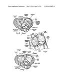 METHODS OF IMPLANTING A HEART VALVE AT AN AORTIC ANNULUS diagram and image