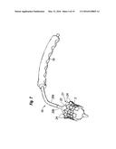 METHODS OF IMPLANTING A HEART VALVE AT AN AORTIC ANNULUS diagram and image