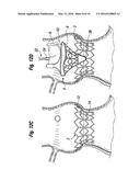 METHODS OF IMPLANTING A HEART VALVE AT AN AORTIC ANNULUS diagram and image