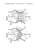 METHODS OF IMPLANTING A HEART VALVE AT AN AORTIC ANNULUS diagram and image