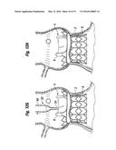 METHODS OF IMPLANTING A HEART VALVE AT AN AORTIC ANNULUS diagram and image