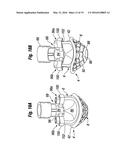 METHODS OF IMPLANTING A HEART VALVE AT AN AORTIC ANNULUS diagram and image