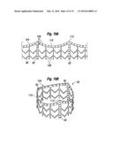 METHODS OF IMPLANTING A HEART VALVE AT AN AORTIC ANNULUS diagram and image